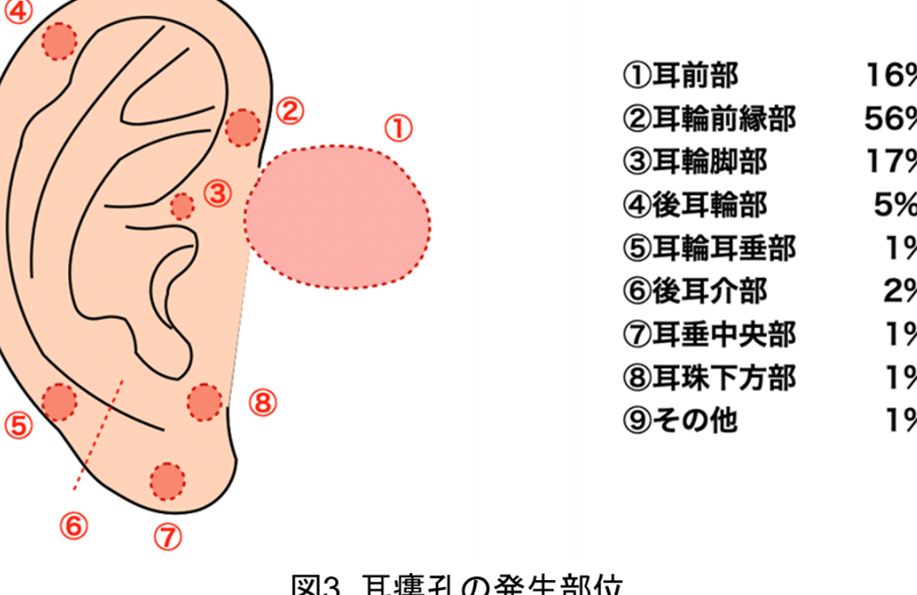 先天性耳瘻孔の症状・診断・治療法について